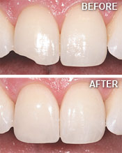 Before and After Tooth Bonding.