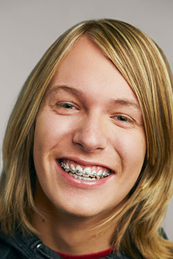Traditional Metal Braces.